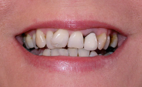 Dental Veneers of Celeb Jaws Health